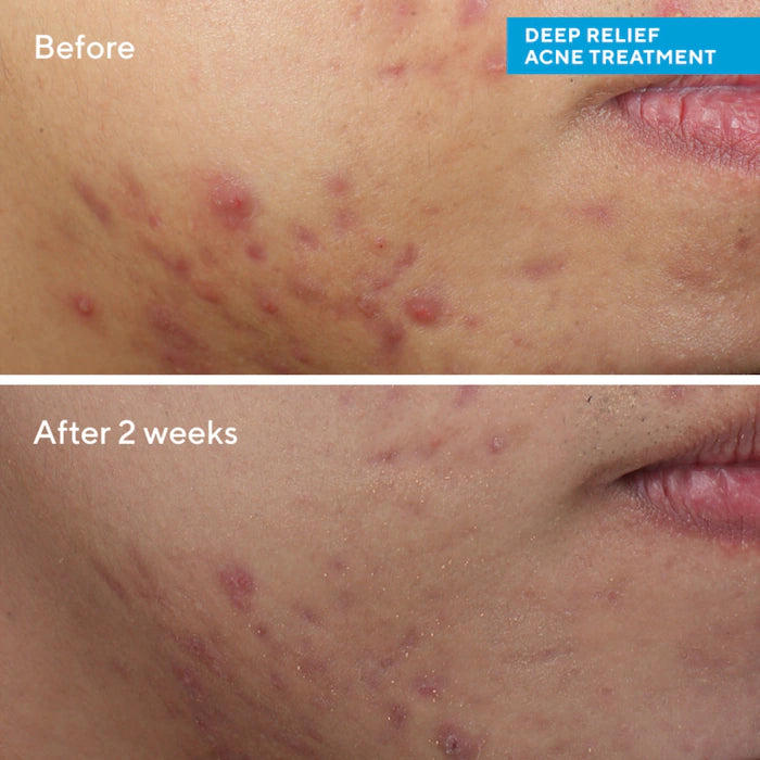 MURAD Deep Relief Acne Treatment with Salicylic Acid