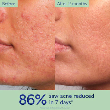 CAUDALIE VINOPURE ACNE- PRONE SKIN ESSENTIALS *PRE - ORDER*